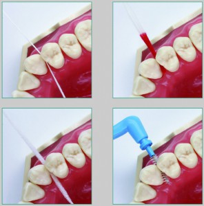 Zahnzwichenräume Putzmethoden