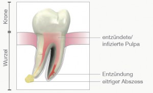 Zahnentzündungen